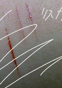 リスカ日記（アムカ）